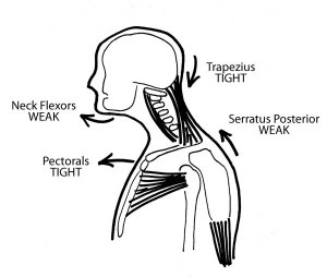CrossedSyndrome The "Crossed Syndrome" of tension and weakness