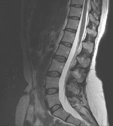 MRI-lumbar Lumbar MRI